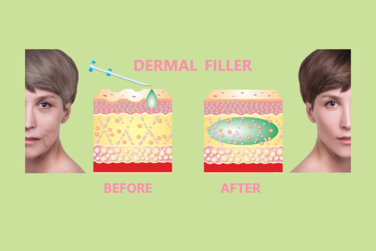 Fillers