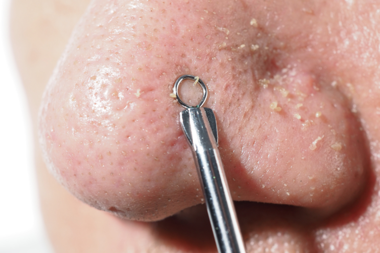 Comedone Extraction​