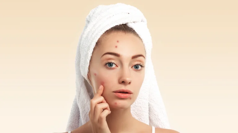 Understanding Acne
