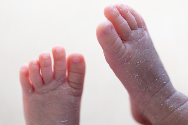 Allergic Contact Dermatitis