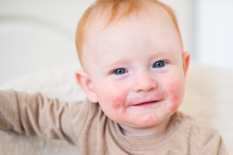 Atopic Dermatitis